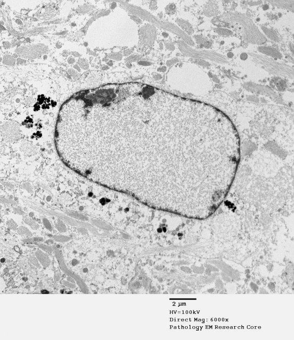 1A4 Artifact, nuclear, mimics viral inclusion (Case 1) EM 064 - Copy