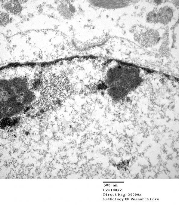 1A5 Artifact, nuclear, mimics viral inclusion (Case 1) EM 068 - Copy