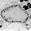 1A6 Artifact, nuclear, mimics viral inclusion (Case 1) EM 074 - Copy