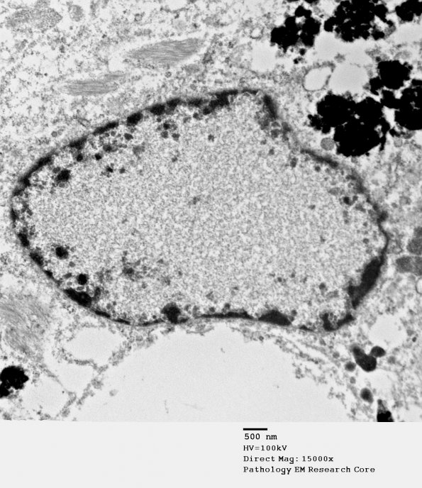 1A6 Artifact, nuclear, mimics viral inclusion (Case 1) EM 074 - Copy