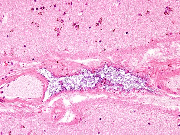 10 Artifacts, terminal sepsis plus formalin pigment (Case 8) H&E 2