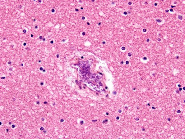 11 Bacteria, postmortem overgrowth (Case 11) H&E 1