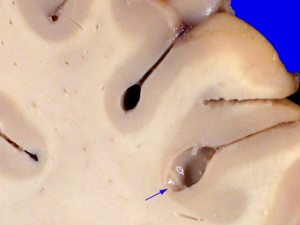 1A4 Artifact, terminal Clostridium sepsis (Case 1) 6