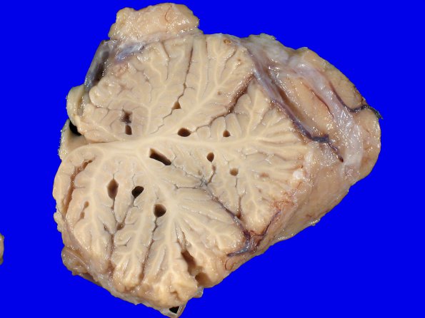 1A5 Artifact, terminal Clostridium sepsis (Case 1) 7A