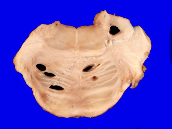 1A7 Artifact, terminal Clostridium sepsis (Case 1) 10A