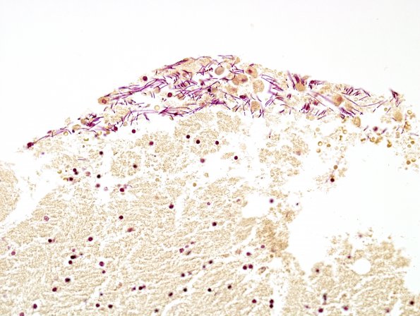 1B10 Artifact, terminal Clostridium sepsis ventricle (Case 1) Gram 2.jpg