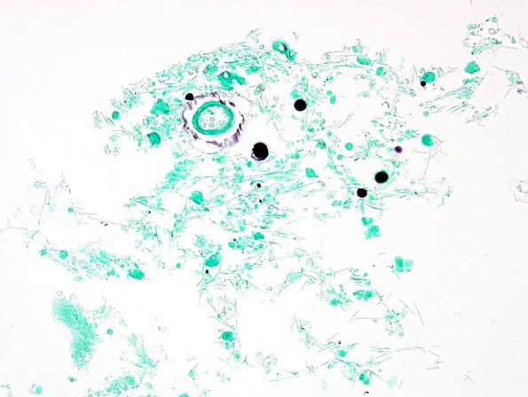 1B11 Artifact, terminal Clostridium sepsis ventricle (Case 1) 3 GMS-