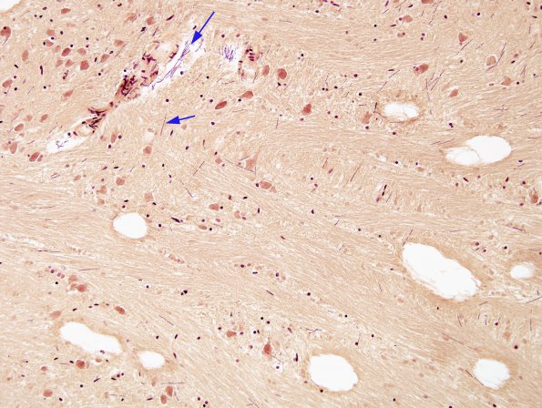 1B2 Artifact, terminal Clostridium sepsis (Case 1) Gram 2