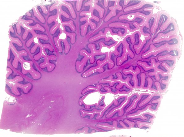 1B3 Artifact, terminal Clostridium sepsis  (Case 1) H&E 5