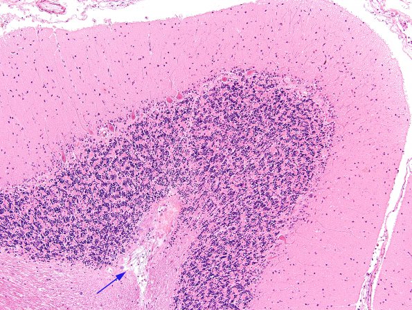 1B4 Artifact, terminal Clostridium sepsis (Case 1) H&E 2