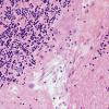 1B5 Artifact, terminal Clostridium sepsis (Case 1) H&E 3