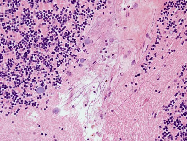 1B5 Artifact, terminal Clostridium sepsis (Case 1) H&E 3