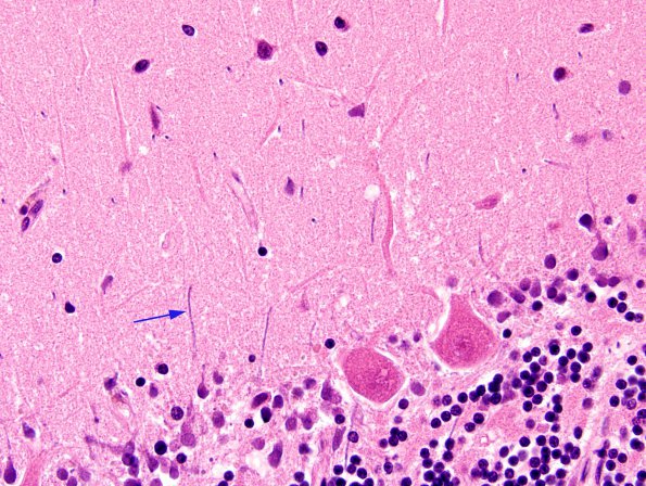 1B6 Artifact, 2 terminal Clostridium sepsis (Case 1) H&E 4