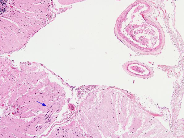 1B7 Artifact, terminal Clostridium sepsis (Case 1) H&E 6