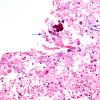 1B9 Artifact, terminal Clostridium sepsis ventricle (Case 1) 1 H&E 2