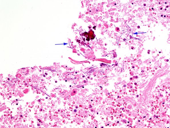 1B9 Artifact, terminal Clostridium sepsis ventricle (Case 1) 1 H&E 2