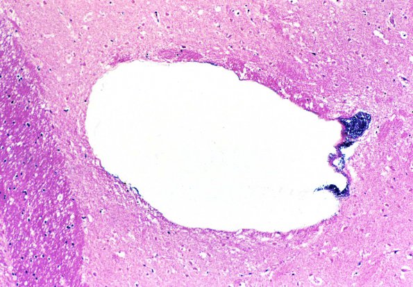 2A1 Artifact, terminal sepsis H&E 1