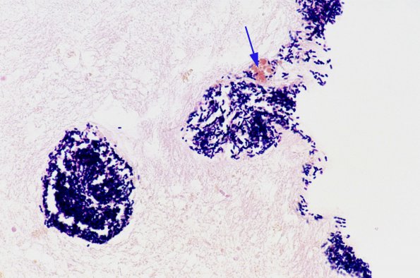 2A2 Artifact, terminal sepsis Gram 1