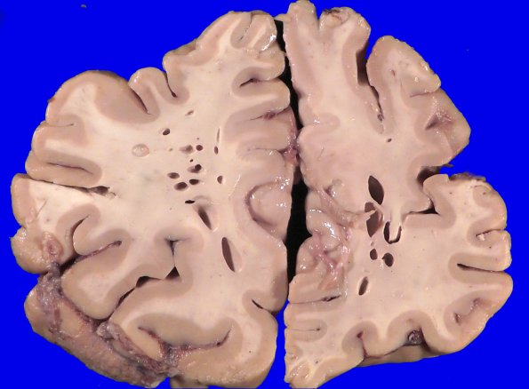 34A2 Swiss Cheese Brain (Case 12) Gross _2
