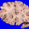 34A3 Swiss Cheese Brain (Case 12) Gross _3