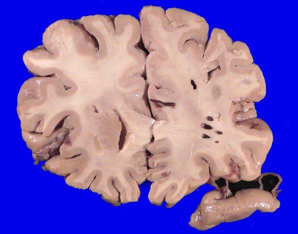 34A3 Swiss Cheese Brain (Case 12) Gross _3