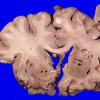 34A5 Swiss Cheese Brain (Case 12) Gross _5