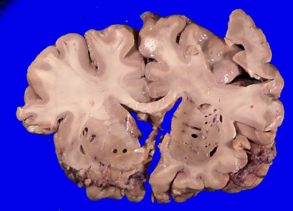 34A5 Swiss Cheese Brain (Case 12) Gross _5