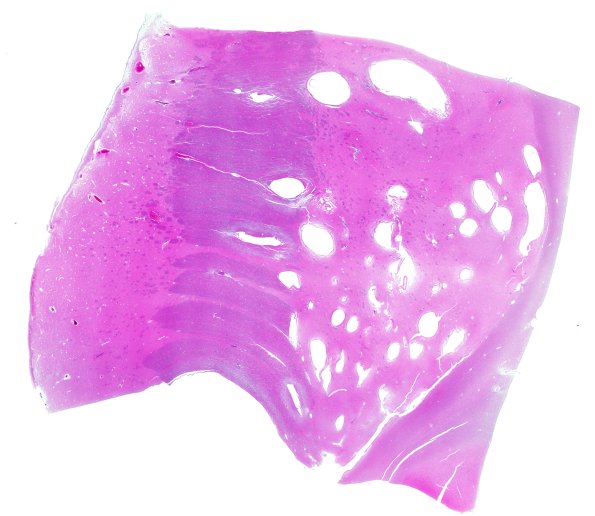 34B1 Swiss Cheese Brain (Case 12) N13 wm