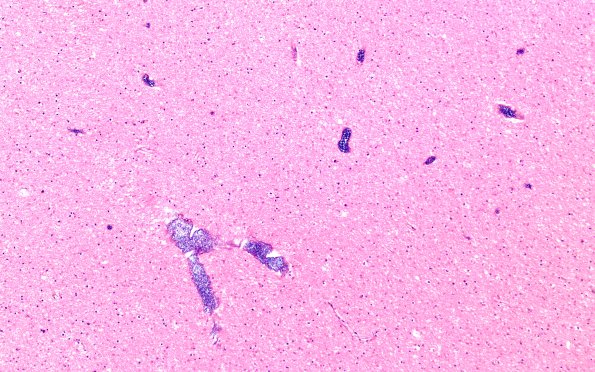 34B3 Swiss Cheese Brain (Case 12) 10X 1