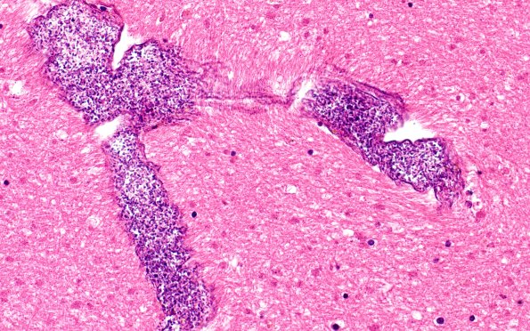 34B4 Swiss Cheese Brain (Case 12) 40X 1