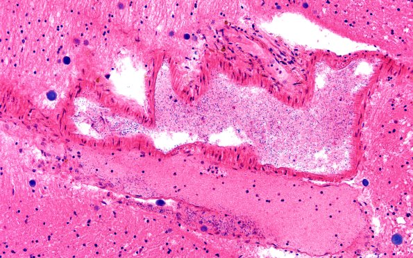 34B5 Swiss Cheese Brain (Case 12) 20X 1