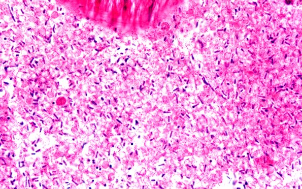 34B6 Swiss Cheese Brain (Case 12) 100X 1