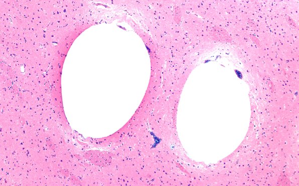 34B7A Swiss Cheese Brain (Case 12) N13 10X 1