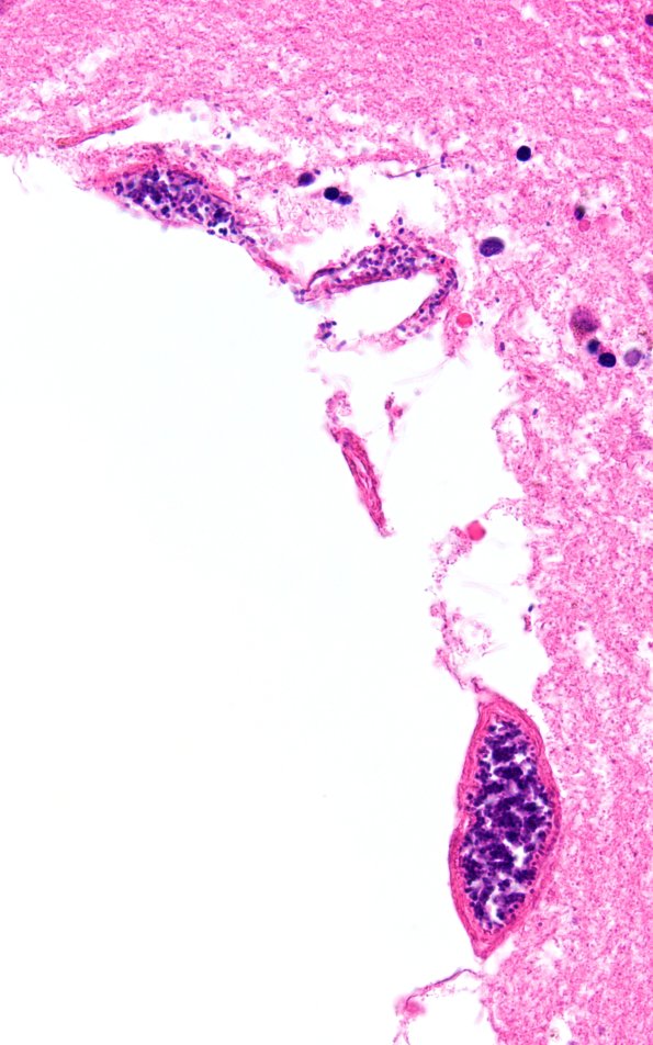 34B7D Swiss Cheese Brain (Case 12) N13 60X 2A