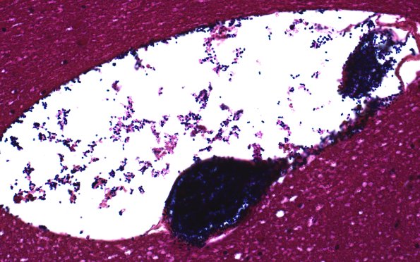 34C1A Swiss Cheese Brain (Case 12) Gram Best 40X