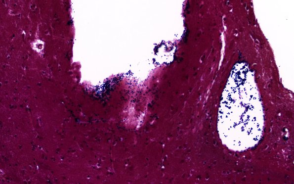 34C2A Swiss Cheese Brain (Case 12) Gram 40X 6