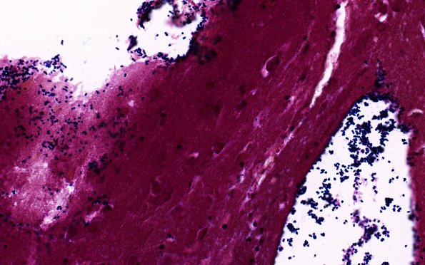 34C2B Swiss Cheese Brain (Case 12) Gram 40X 7