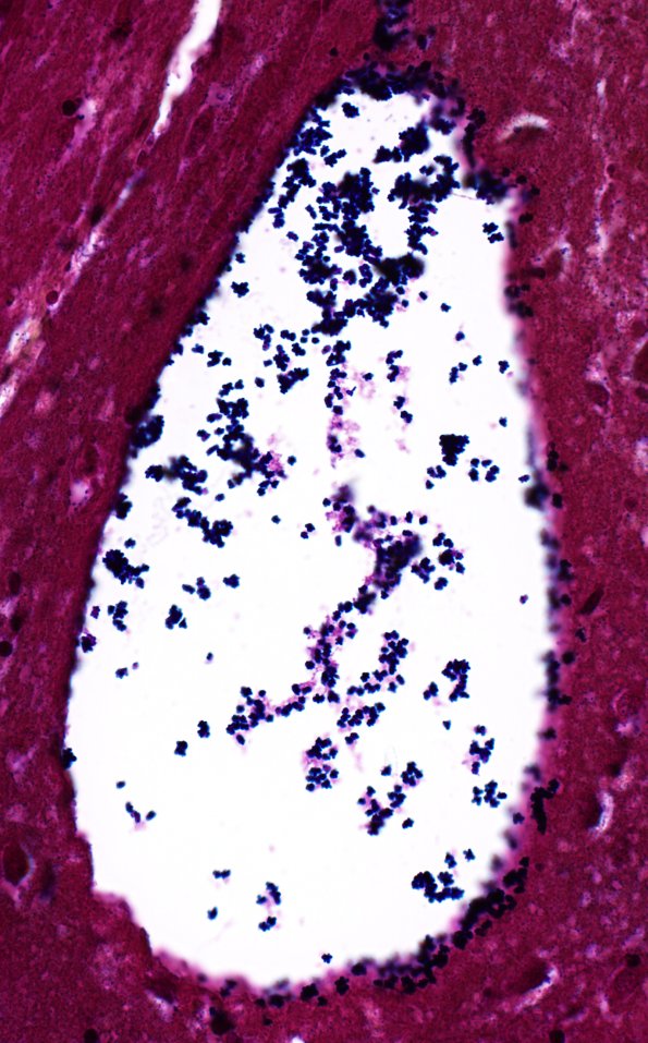 34C2C Swiss Cheese Brain (Case 12) Gram 40X 4