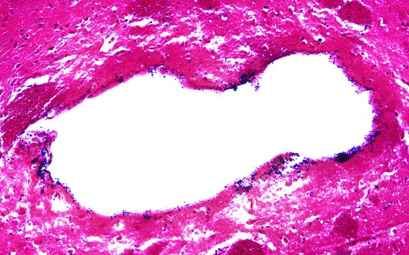 34C3A Swiss Cheese Brain (Case 12) Gram 20X 2