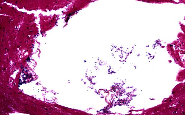 34C4A Swiss Cheese Brain (Case 12) Gram 20X 3