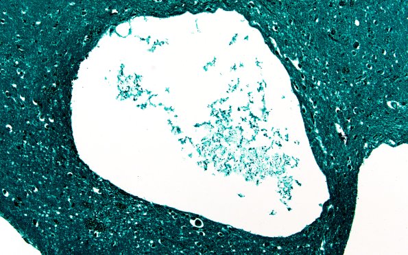 34D1A Swiss Cheese Brain (Case 12) GMS 20X 2