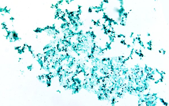 34D1B Swiss Cheese Brain (Case 12) GMS 60X 2