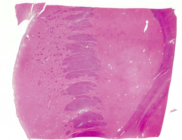 3A1 Artifact, infarct plus bacterial overgrowth (Case 12) BG H&E 1