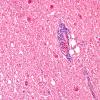 3A2 Artifact, infarct plus bacterial overgrowth (Case 12) BG H&E 5