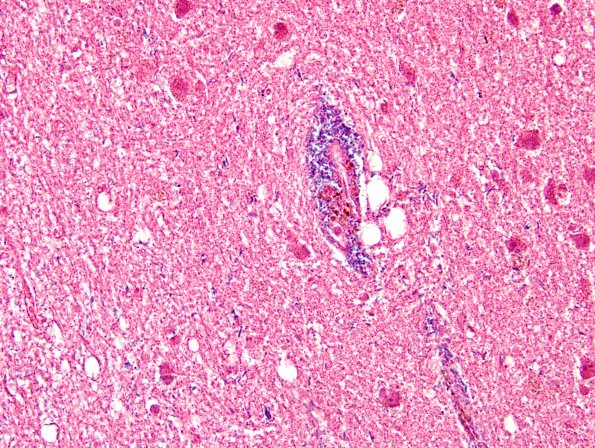 3A2 Artifact, infarct plus bacterial overgrowth (Case 12) BG H&E 5