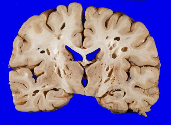 5 Artifact, terminal sepsis (Case 4)A