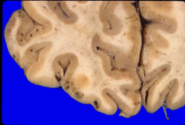 6 Artifact, terminal sepsis (Case 10) 1a