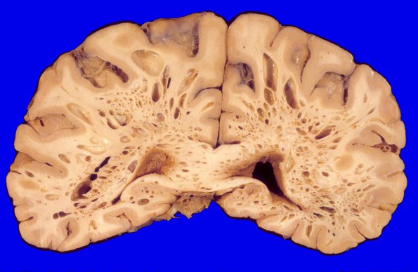 7A1 Artifact, terminal sepsis (Case 13) 1A