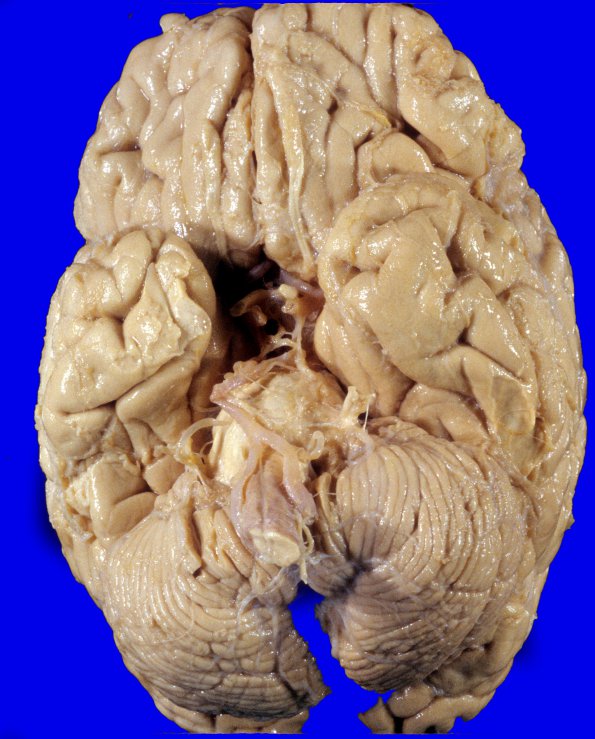 8A1 Artifact, terminal sepsis (Case 15) 1A