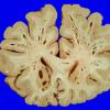 8A2 Artifact, terminal sepsis (Case 15) 2A